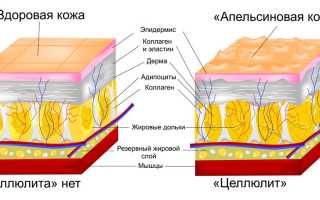 Как быстро и эффективно избавиться от целлюлита на ногах без усилий