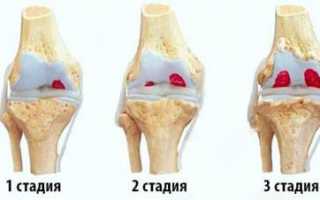 Есть ли польза от уколов в сустав?