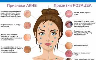 Розацеа: причины, симптомы, диагностика, лечение и профилактика
