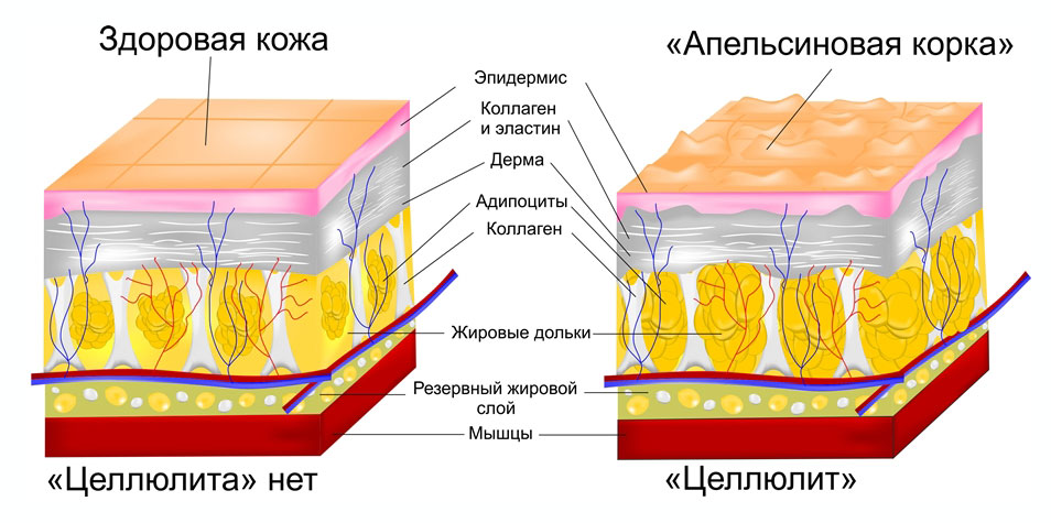 Строение верхнего слоя дермы у человека с целлюлитом и без него