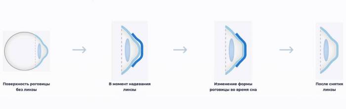 Что такое ночные линзы MoonLens?